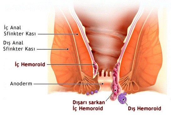 hemoroid